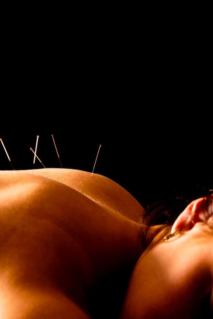 Close-up of acupuncture needles set along a person's upper back against a dark ground.